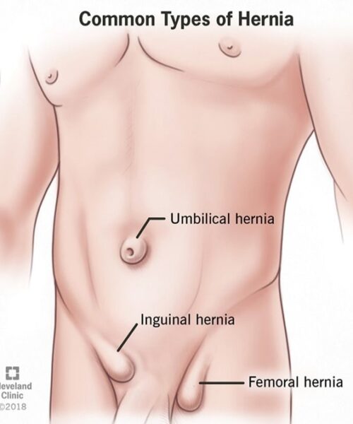 common Hernias