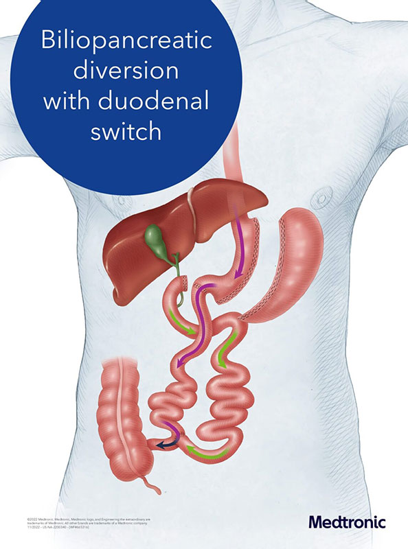A diagram of a duodenal switch in Plano.