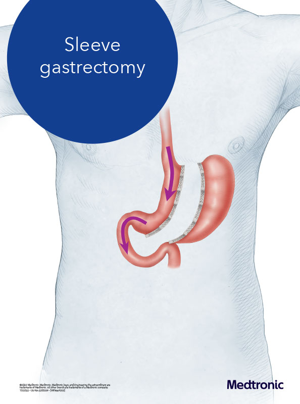 Diagram showing a gastric sleeve in Waxahachie.
