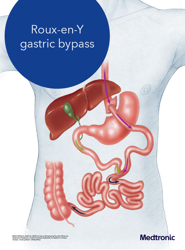 Diagram of gastric bypass in Waxahachie.